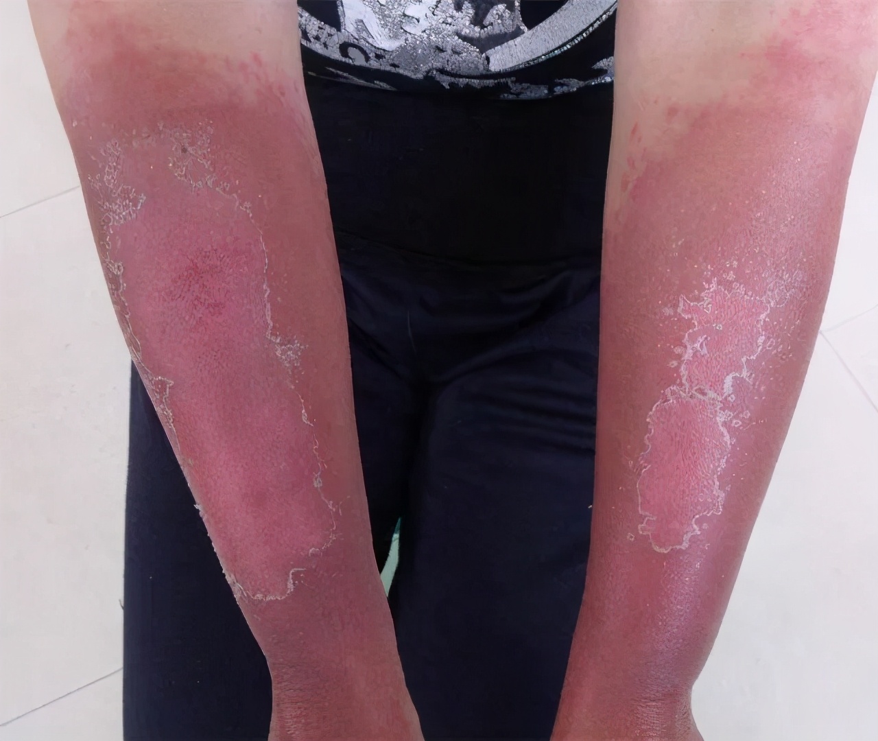 炎炎夏日来临,极容易忽视的4类皮炎,看过的人早预防