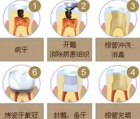 雅悦齿科：为什么根管治疗费用那么贵？那可全是牙医的技术啊！