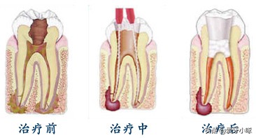 牙齿松动怎么办？别急！这几种方法来解救你