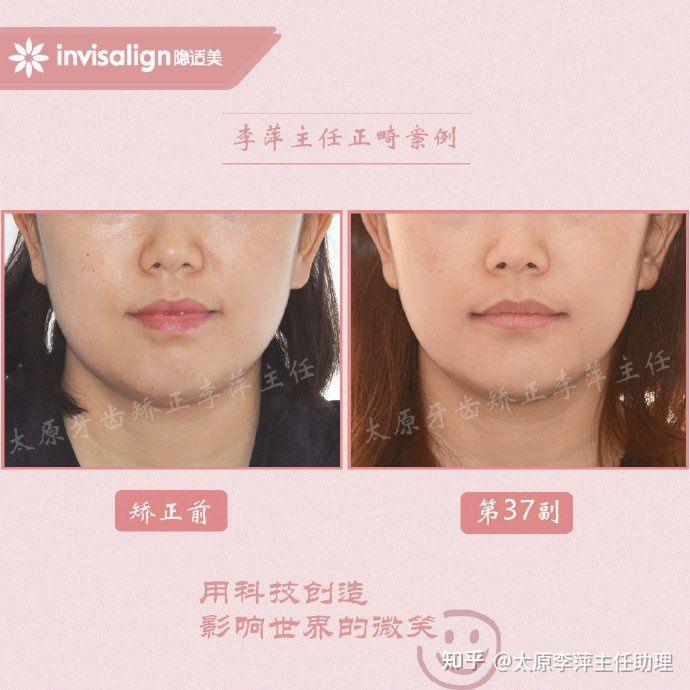 太原牙齿矫正：隐形牙套效果好不好？看这些病例你就知道了