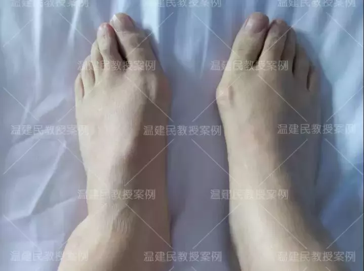 这位患者拇外翻拖了20年,畸形疼痛越来越重,10分钟手术就矫正