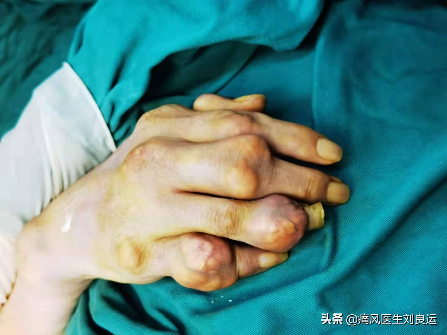 男子痛风后病急乱投医被误诊为腱鞘炎，不规范治疗双手长出痛风石