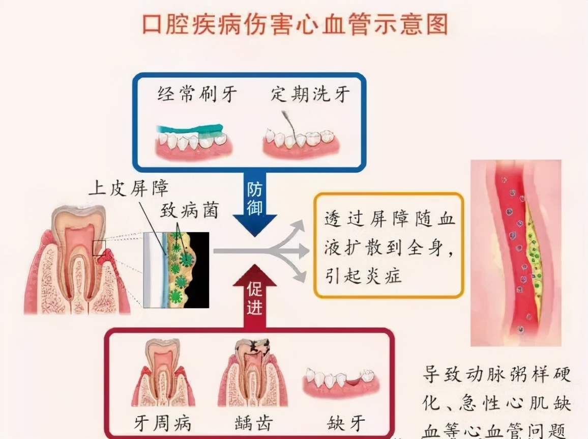 刷牙总出血，很可能是牙齿在喊救命