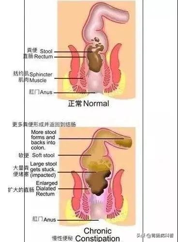 慢性便秘该如何治疗？