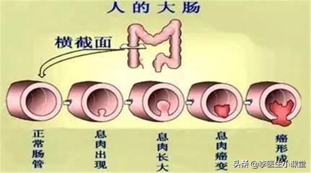 医生提醒：肠息肉切除后，饮食上做到这几点，伤口好得更快