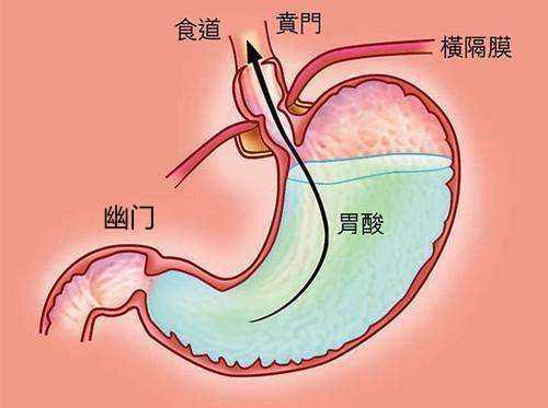 胃烧心反酸困扰怎么办？简单实用的缓解方法