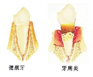 牙周炎原因及治疗方法（送你一份牙周炎治疗指南）