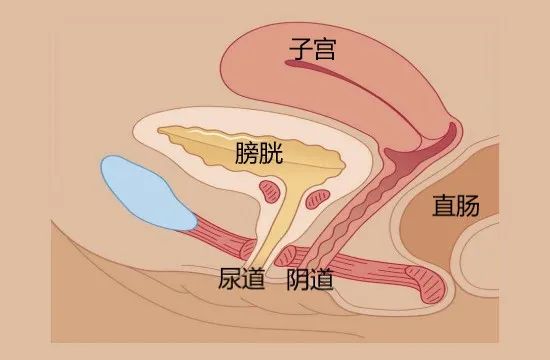 膀胱子宫陷凹图片