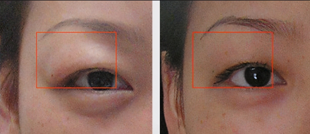 你的肿泡眼属于什么类型?你能做什么样的双眼皮(内附案例)