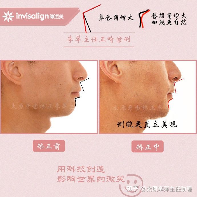 太原牙齿矫正：隐形牙套效果好不好？看这些病例你就知道了