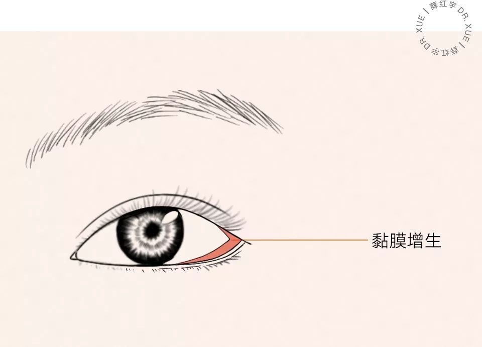 要不要开外眼角？要不要做眼睑下至？