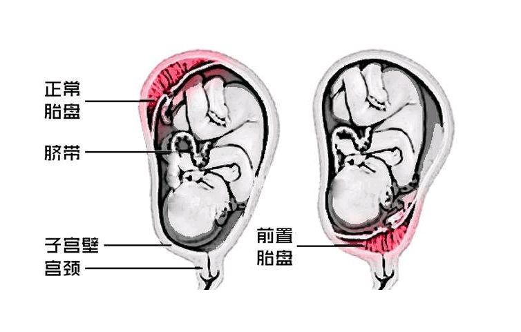 孕妇胎盘前壁好还是后壁好?只要在这个位置都正常,变化了就不行