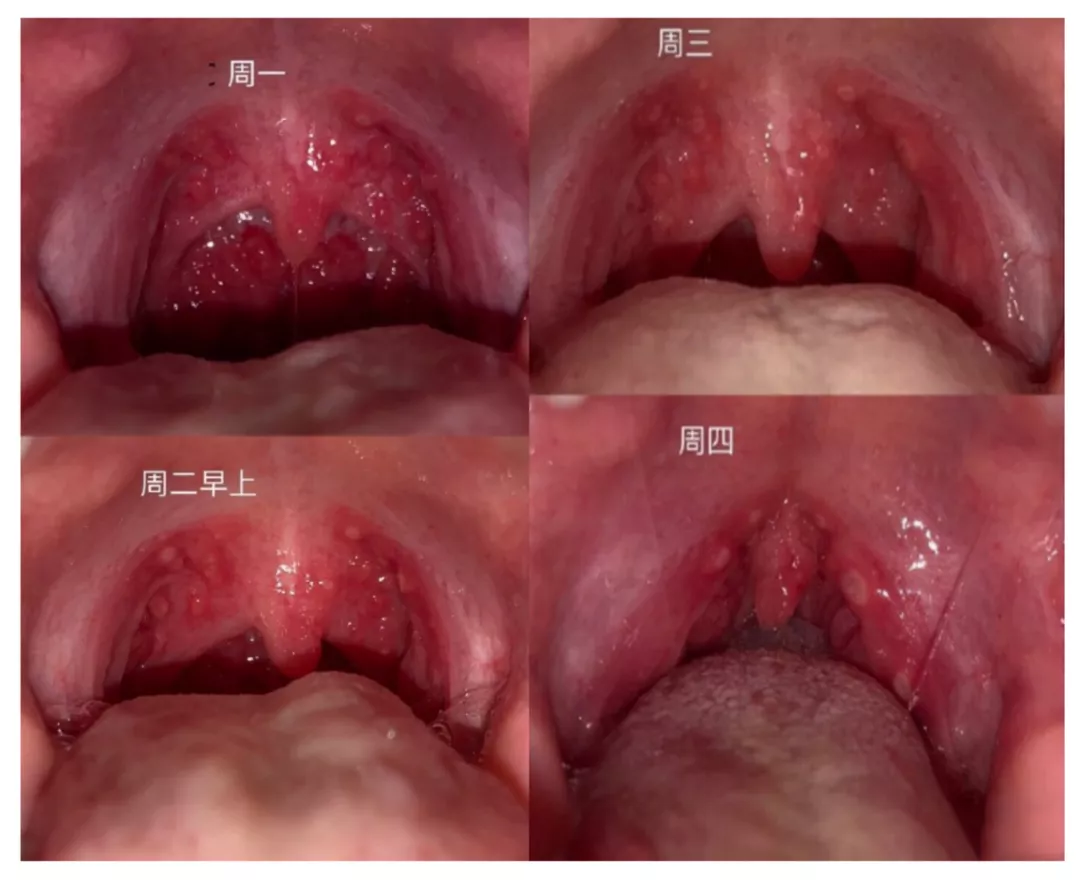 疱疹性咽峡炎起病急、易高烧、传染快！一旦感染，孩子太遭罪！