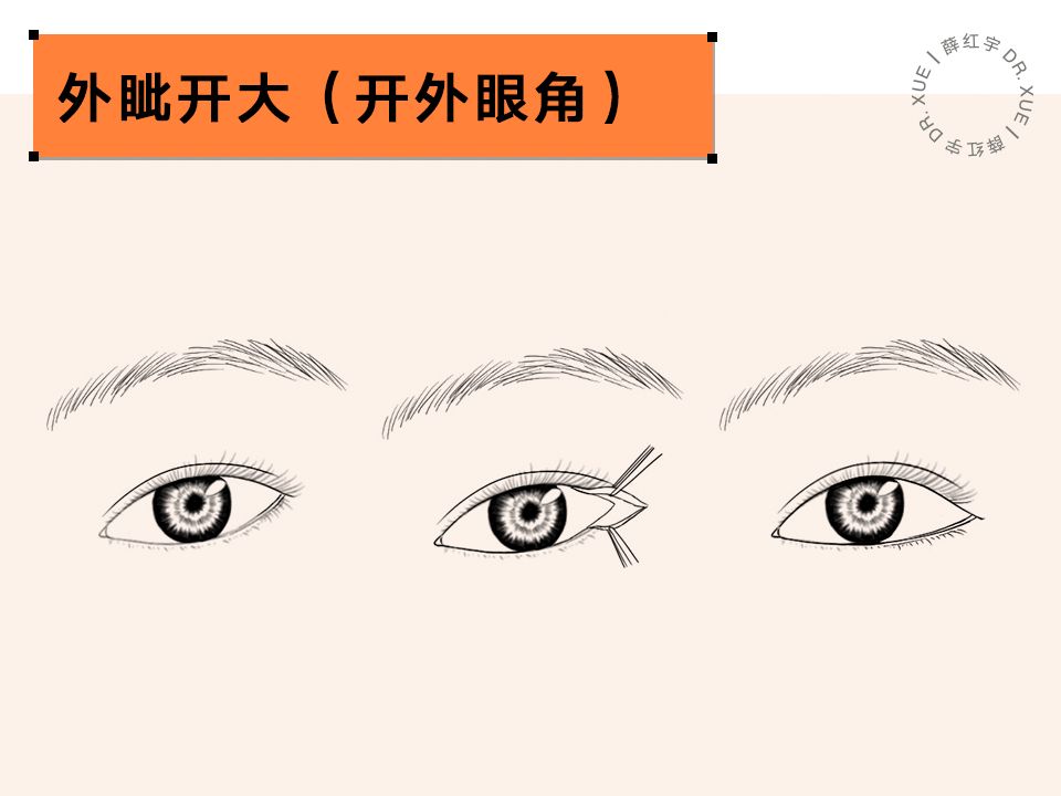 要不要开外眼角？要不要做眼睑下至？