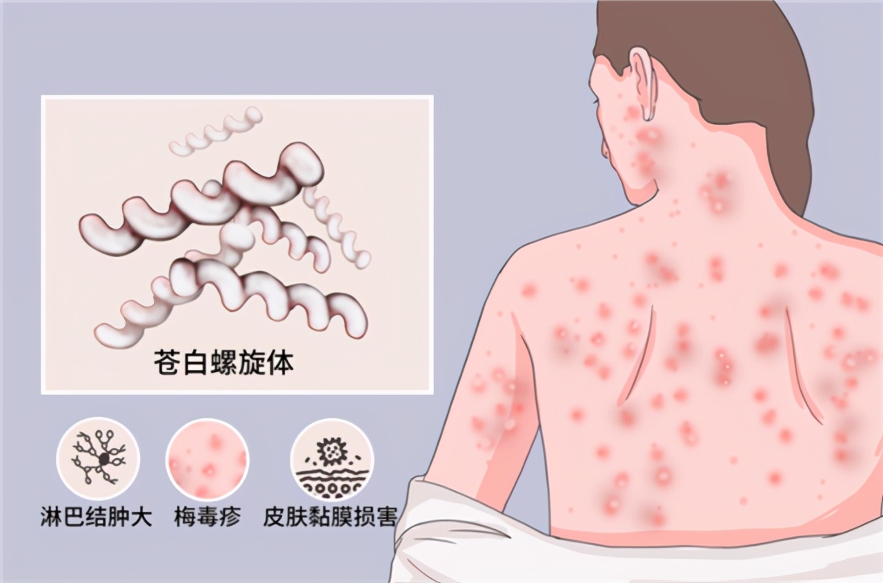 梅毒可以被分为先天获得的胎传梅毒和后天感染的获得性梅毒.