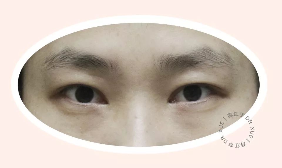 要不要开外眼角？要不要做眼睑下至？