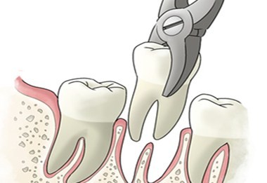 拔牙后多久不疼(12个拔牙小常识：胀痛会持续3～5天，牙龈愈合需要1个月...)