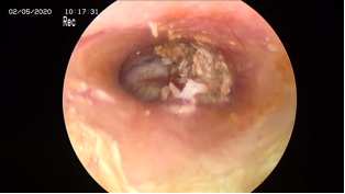 成功拆除患者耳内“定时炸弹”—首例耳内镜下中耳胆脂瘤切除术