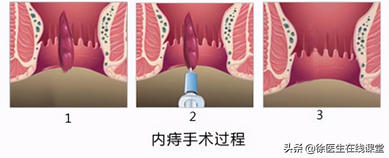 肛门边的肉球，除了痔疮，还可能是什么，需要治疗吗？