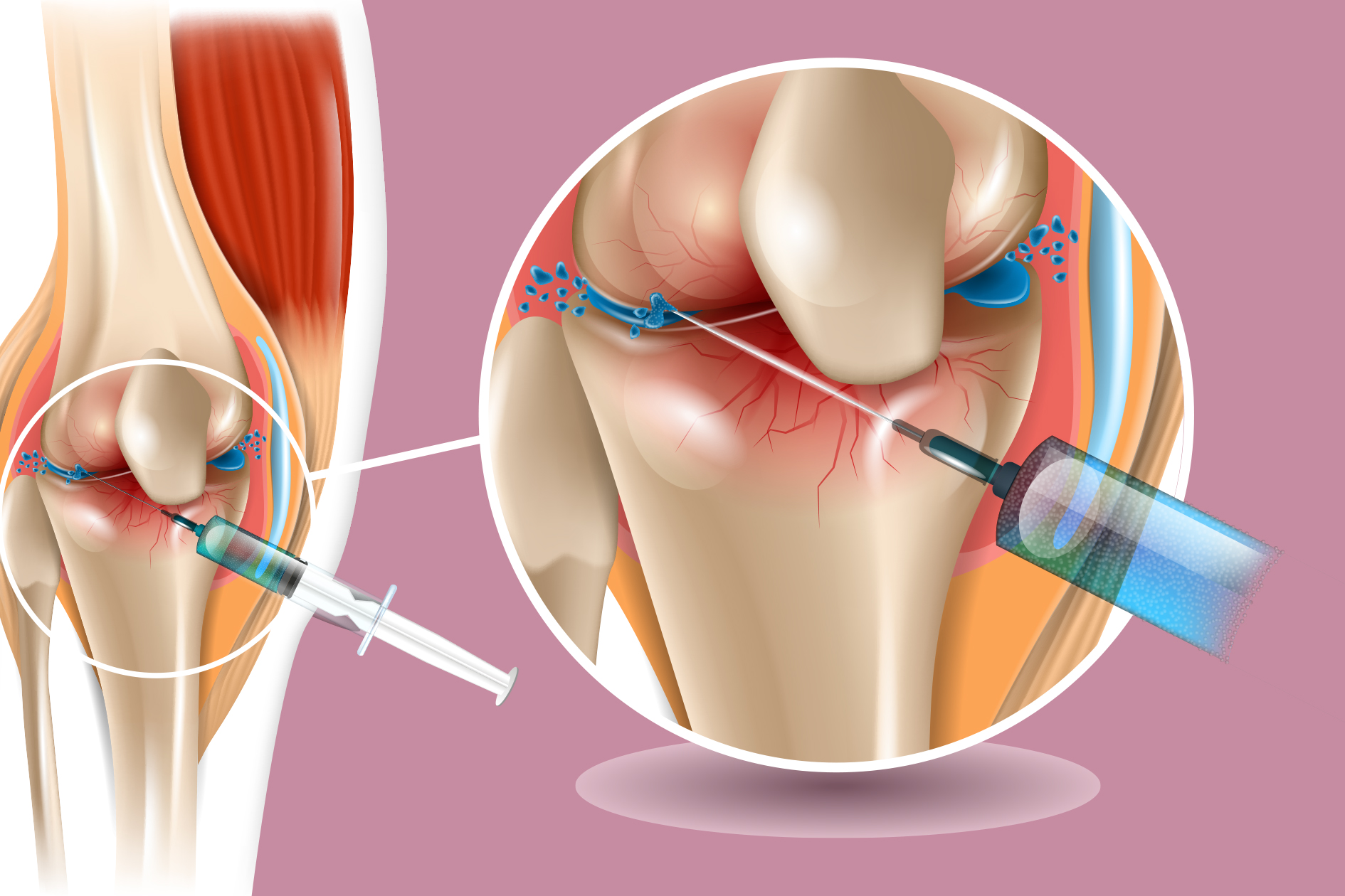膝骨关节炎常用的三种注射治疗，如何正确使用缓解疼痛？