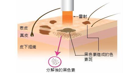 激光祛疤，你到底了解多少？帮你恶补一番！