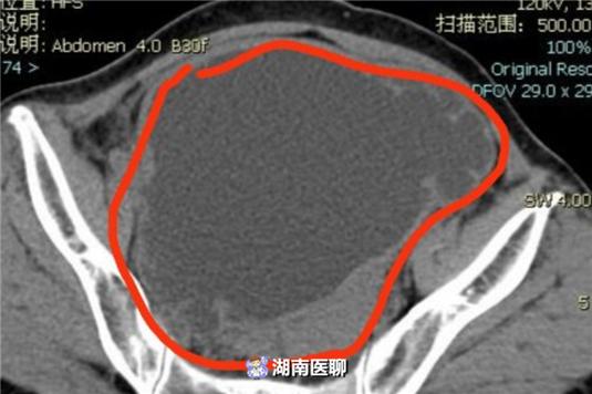 小包块变大囊肿，女子有“痛”难言！女性该如何预防巴氏腺囊肿？