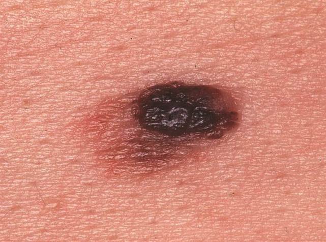 皮肤癌：不论男女，痣出现这5种变化，小心它正在“癌变”
