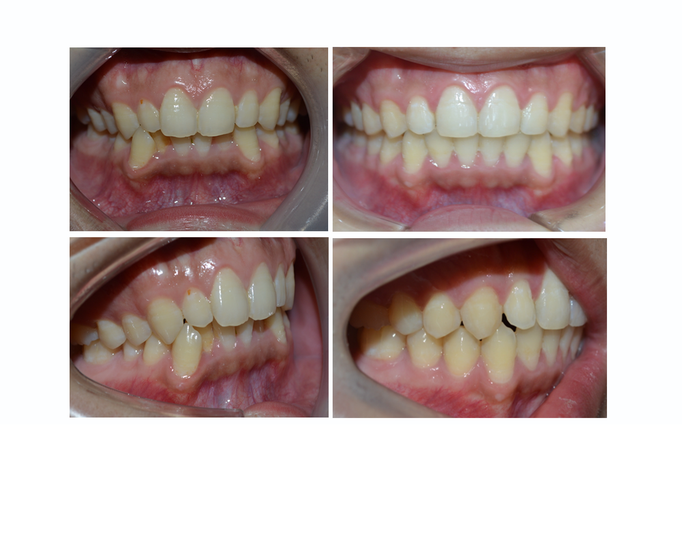 牙齿不齐,除了影响美观,还有什么危害?