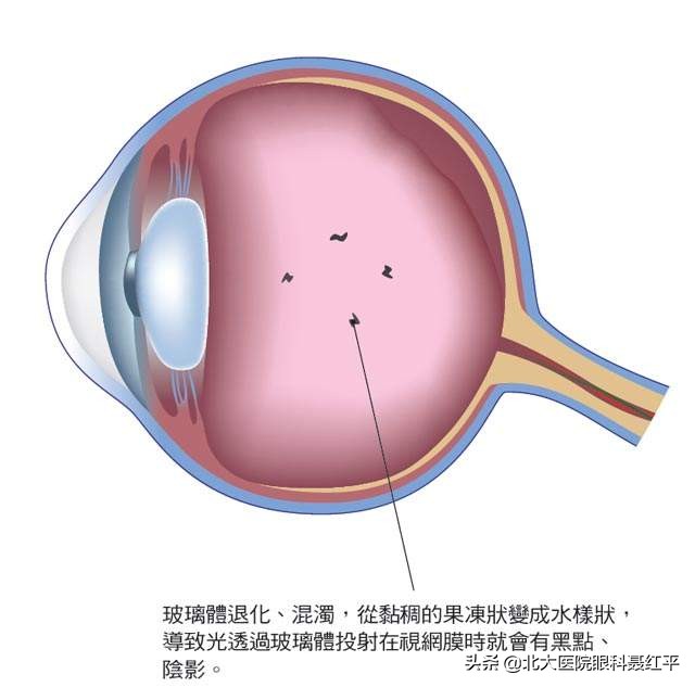 眼睛玻璃体混浊飞蚊症的治疗方法与改善措施