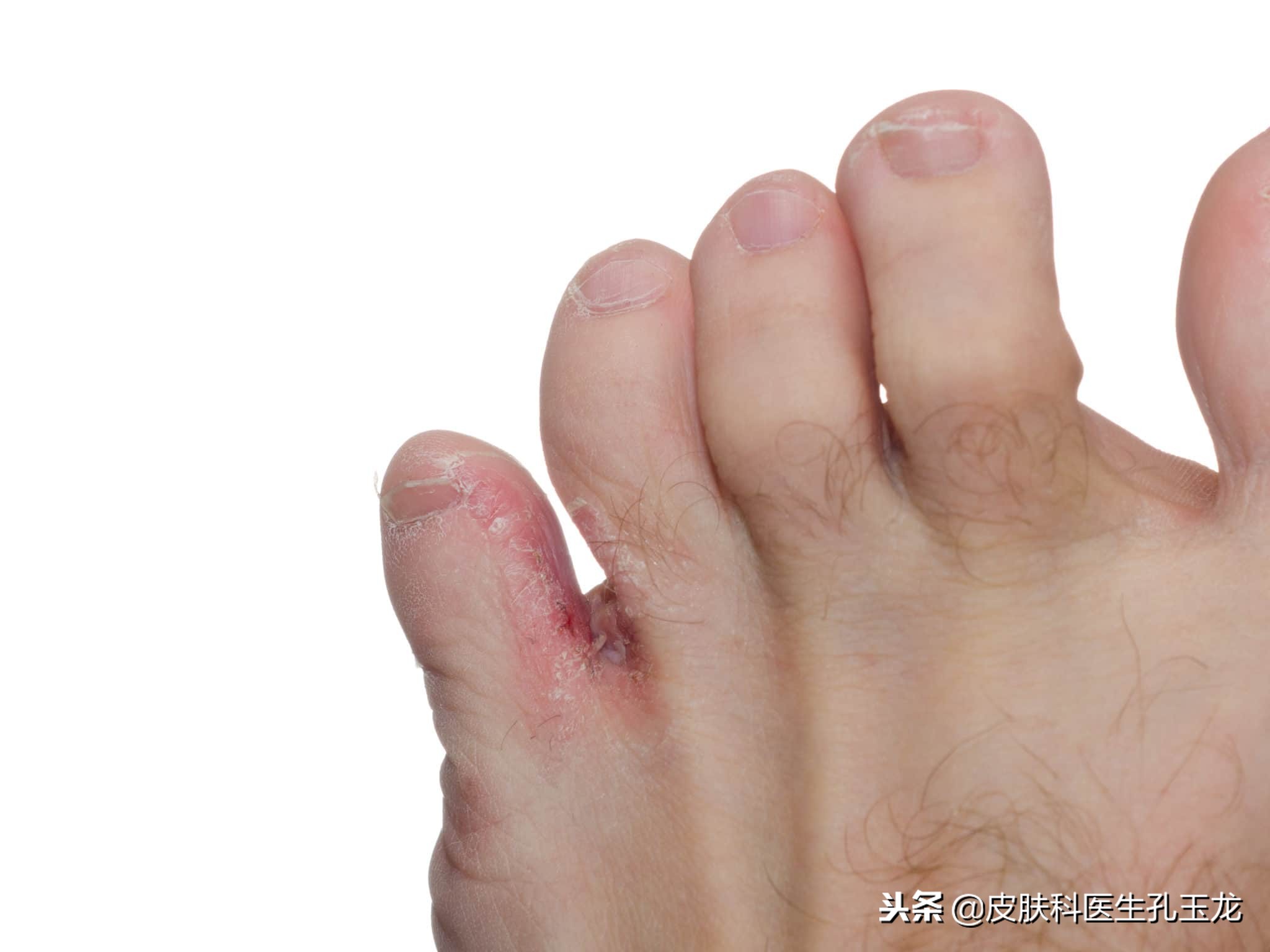皮肤常见疾病系列:顽固的足癣,脚气,香港脚