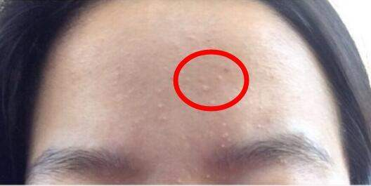 你脸上长的小疙瘩是闭口还是黑头？什么是闭口，哪些产品能祛除？