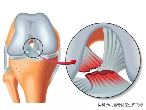 nba有哪些球员韧带撕裂过(nba某球星左膝十字韧带撕裂，运动中要学会保护自己)