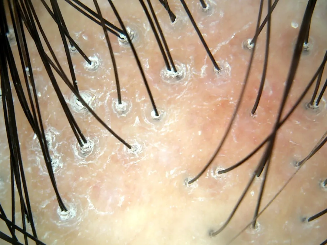 你是我的眼皮肤毛囊在组织免疫荧光下的表现(小鼠)毛球(毛囊底部)是