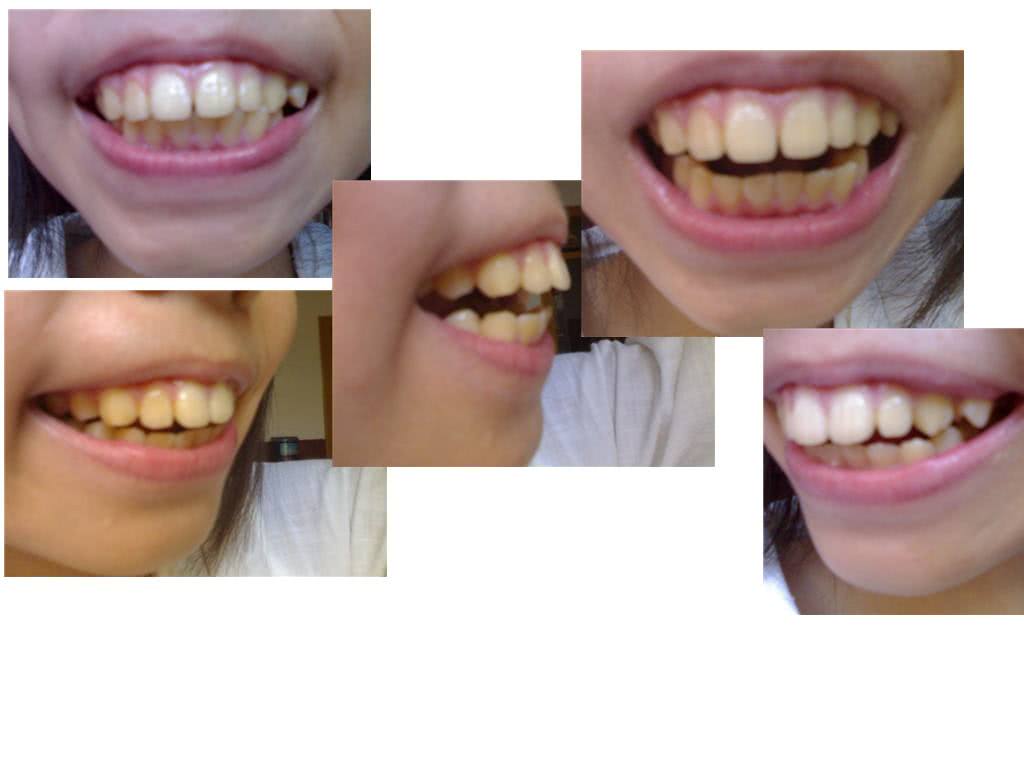 如何知道暴牙矯正的效果好不好？齒性與骨性暴牙的區分與矯正。 | 茉莉牙醫