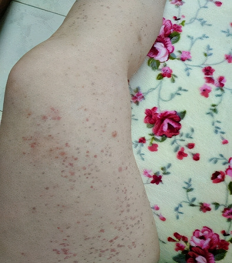 皮肤长红痣有哪些原因?