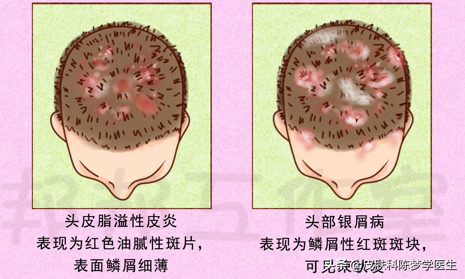 头皮银屑病可单独发生或与全身其它部位皮损伴发.