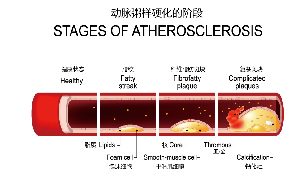 关注血小板的正常值？先看看血小板与血栓的关系！赶紧收藏