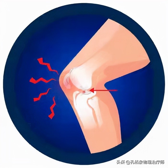 大腿肌肉酸痛及膝关节疼痛的原因分析