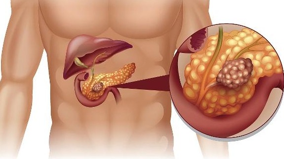 胰腺癌的手術治療又包括:傳統開腹手術,腹腔鏡手術和機器人手術.