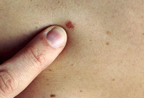 皮肤癌:不论男女,痣出现这5种变化,小心它正在癌变