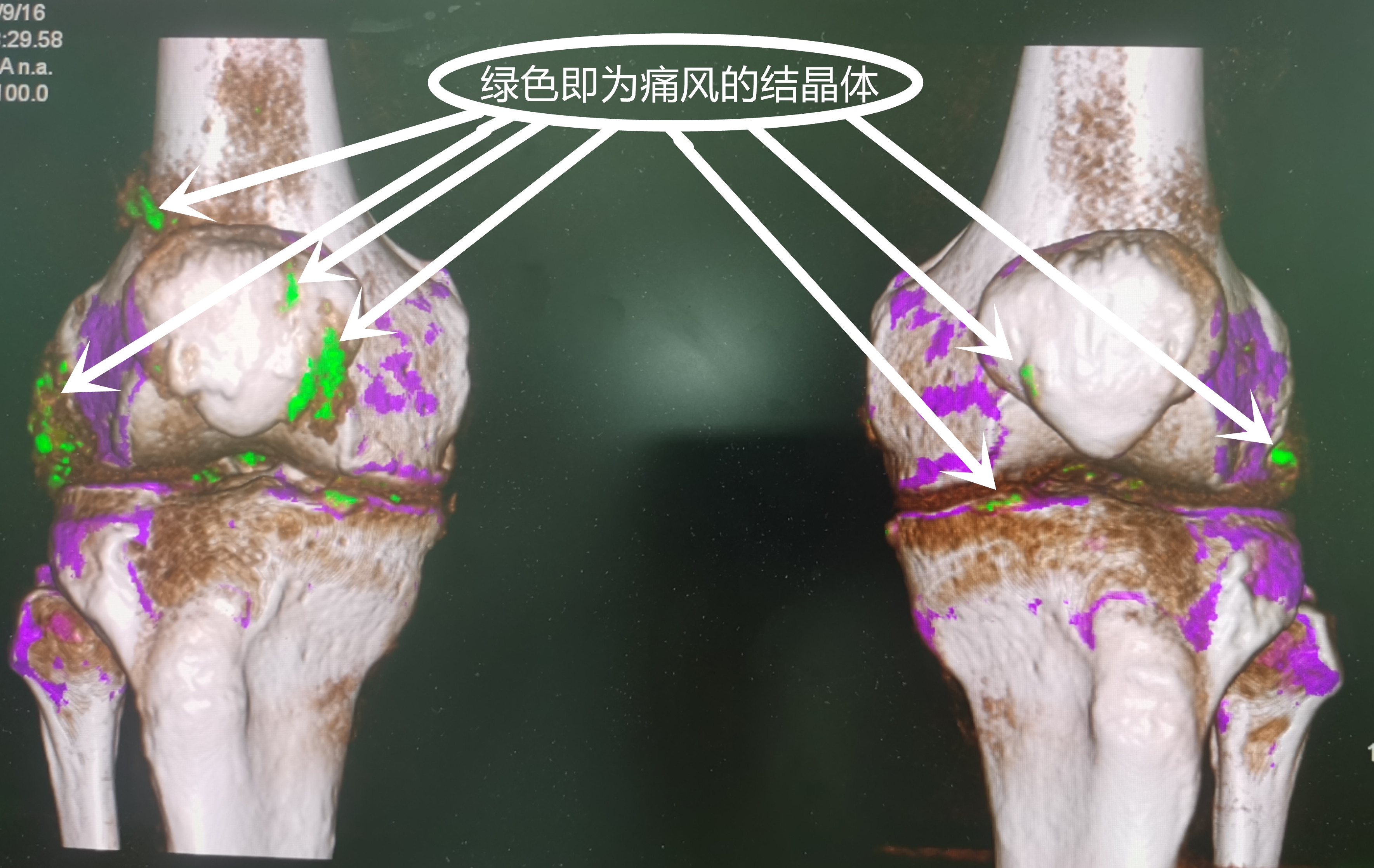 能"解"痛风结晶,会"算"血管狭窄,武汉市肺科医院引入会解方程的双源ct