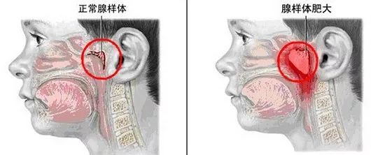 孩子睡觉有这个表现家长要注意！严重可影响智力发育