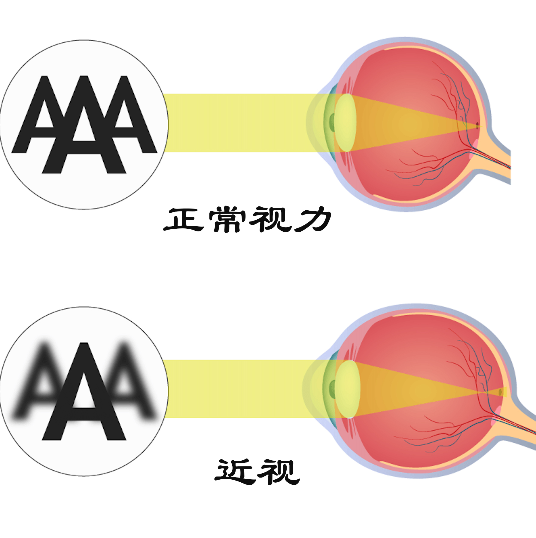 科普：一篇文章详述激光近视矫正手术的那些知识