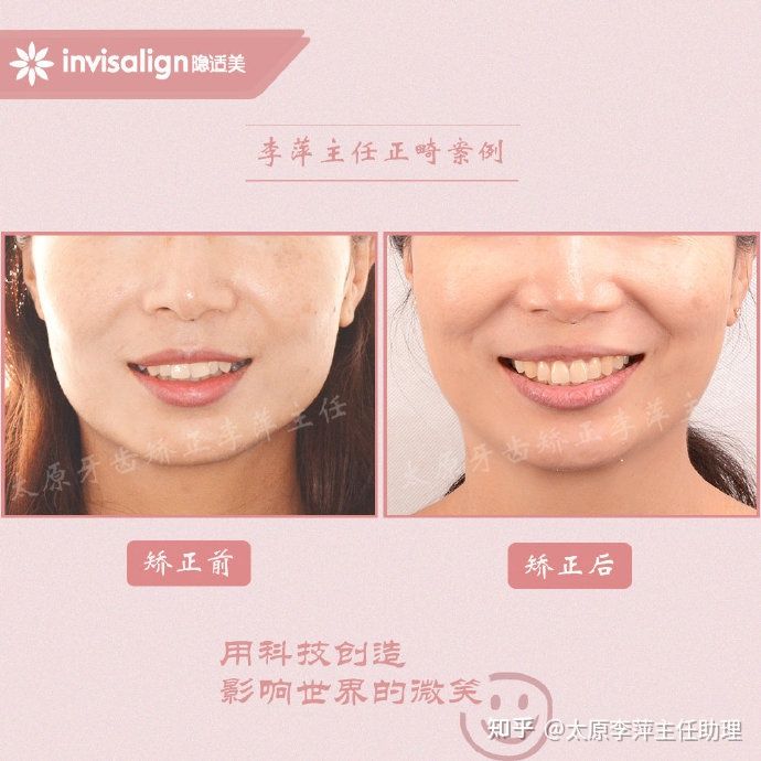 太原牙齿矫正：隐形牙套效果好不好？看这些病例你就知道了