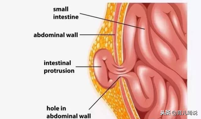 宝宝哭太多会得疝气？关于婴儿疝气的事儿这里全都有科学解释
