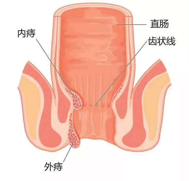 便便变细是肠癌的先兆吗？听听崔医生怎么说