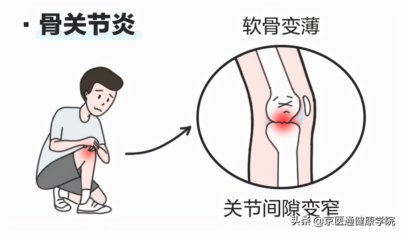 膝蓋疼就是關節炎嗎？積水潭醫生教你分辨