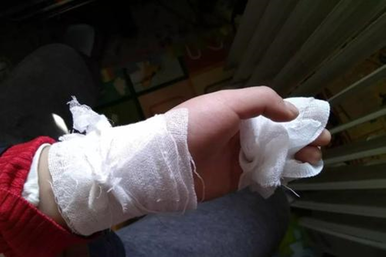 三岁孩子被100度开水烫着，妈妈用1小时4步处理，医生：做得好