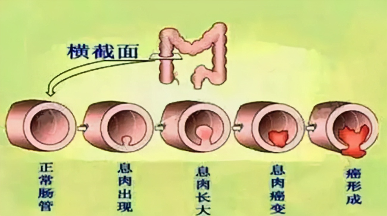 肛门里长了个小肉球是痔疮吗？