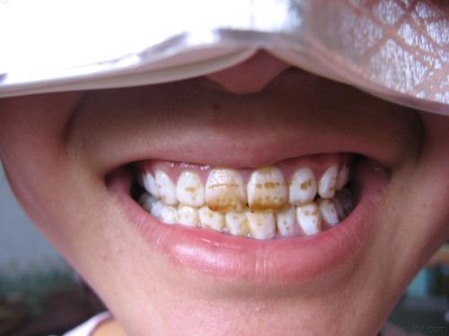 牙齿变黄骨骼变形,神秘的世界性地方病,与饮水氟含量密切相关